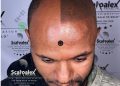 Scalp Micropigmentation – The only hair Loss solution that Guarantees a Result