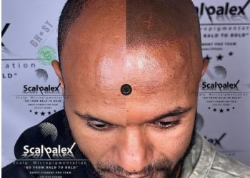 Scalp Micropigmentation – The only hair Loss solution that Guarantees a Result