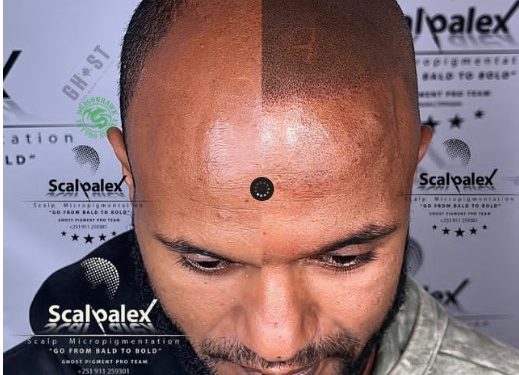 Scalp Micropigmentation – The only hair Loss solution that Guarantees a Result