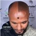 Scalp Micropigmentation – The only hair Loss solution that Guarantees a Result