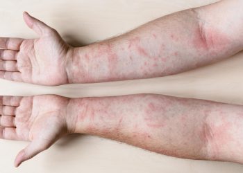 Natural Remedies for Eczema – Effective Ways to Soothe and Heal