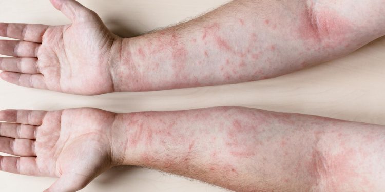 Natural Remedies for Eczema – Effective Ways to Soothe and Heal