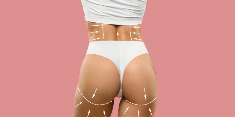 Achieve Your Dream Curves: Everything You Need to Know About Sculptra Butt Lift in London